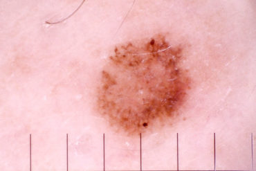 Vyšetření névů a dalších kožních projevů optickým i digitálním dermatoskopem